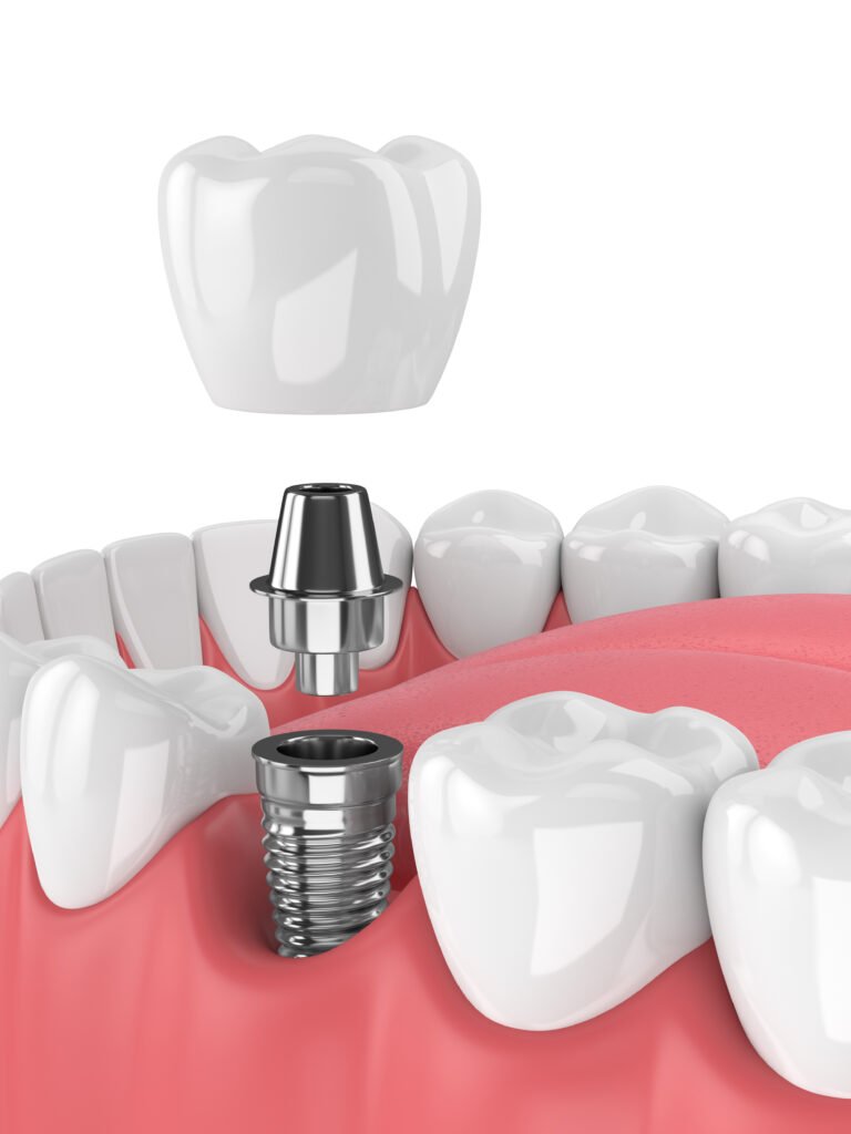 3d render of jaw with teeth and dental molar implant over white background
