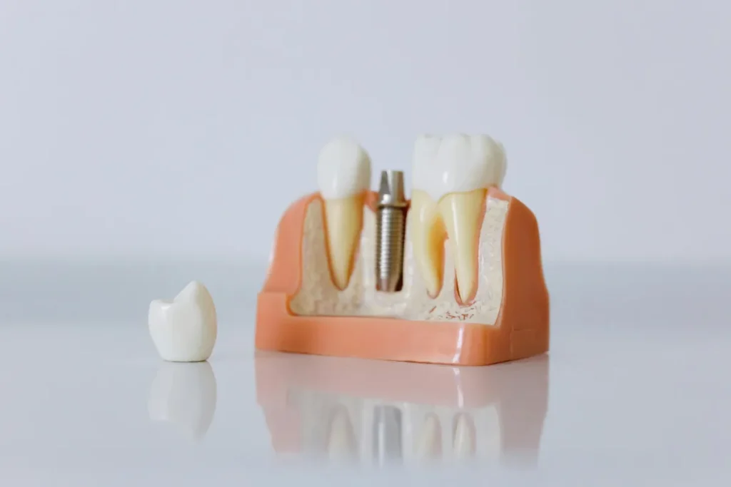 anatomical display of a singular dental implant